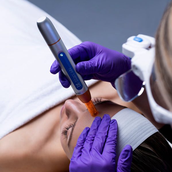 Microneedling