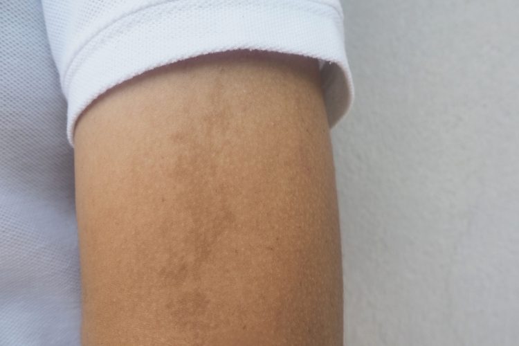 Dark brow birthmark or cafe au lait ma or CLAMs on the arm near elbow.