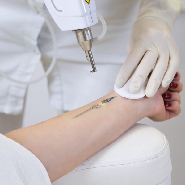 Cosmetologist doing laser tattoo removal from woman hand in cosmetology clinic